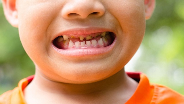 faktor gigi anak cepat rusak