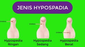 pengertian hipospadia